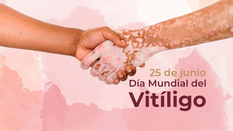 Vitiligo: una enfermedad que requiere alta dosis de sensibilidad familiar